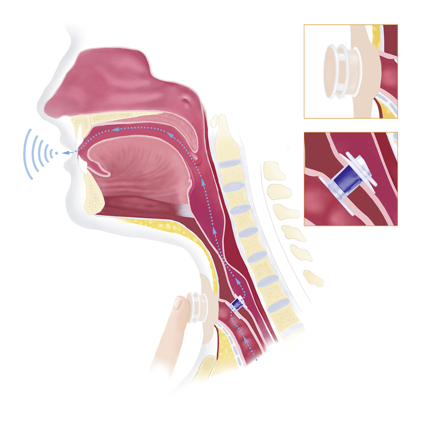 Anatomische Zeichnung: Sprechen mit einer Stimmprothese