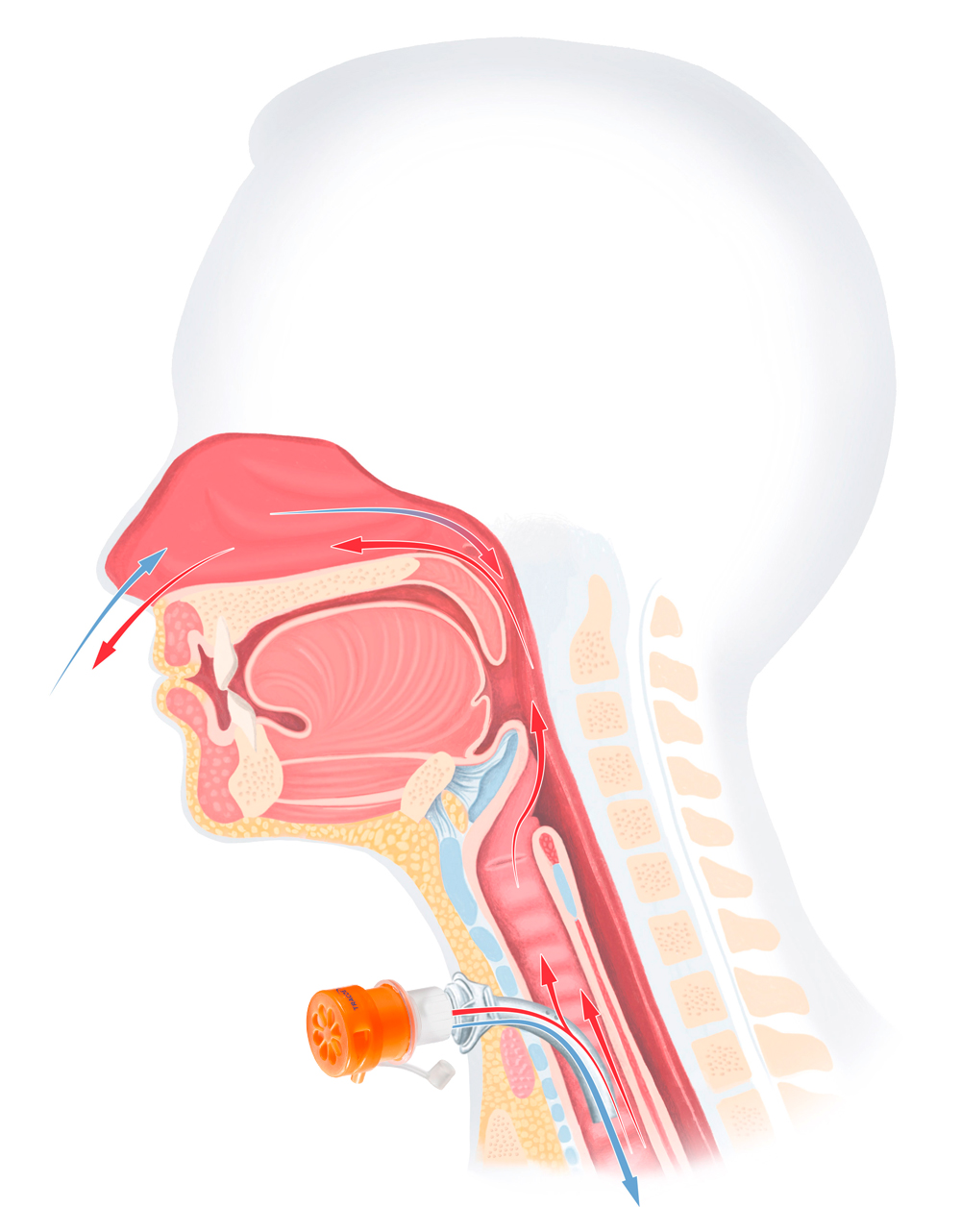 Anatomische Illustration eines Menschen mit Luftzirkulation nach der Tracheotomie. Mit Tracoe Sprechventil.